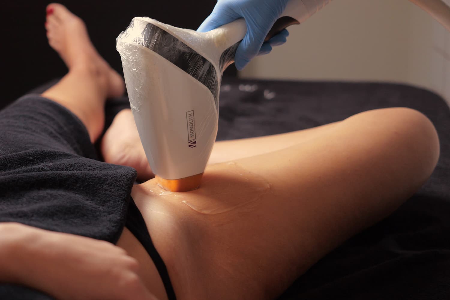 epilazione laser inguine monolith trattamento definitivo